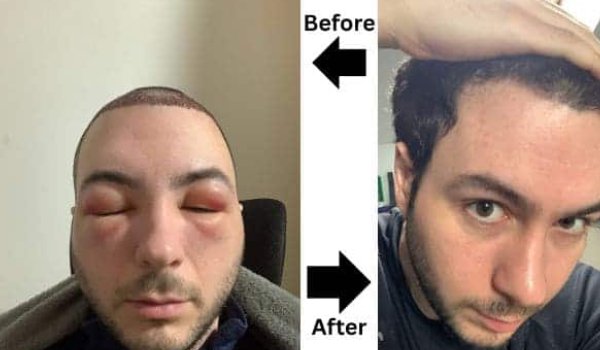 قرص برای کاهش ورم صورت بعد از کاشت مو