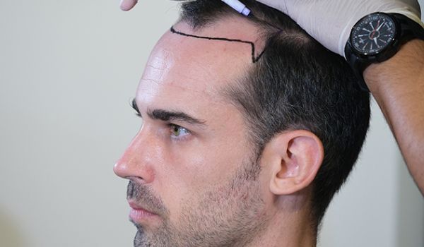 کاشت مو در زمان ریزش مو