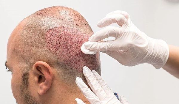 محصولات مراقبتی توصیه شده پس از کاشت